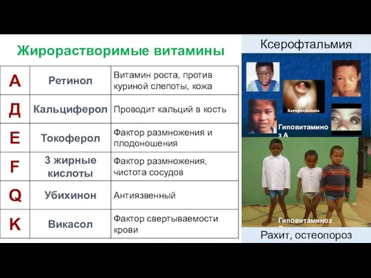 Жирорастворимые витамины Гиповитаминоз А Гиповитаминоз Д Ксерофтальмия Рахит, остеопороз