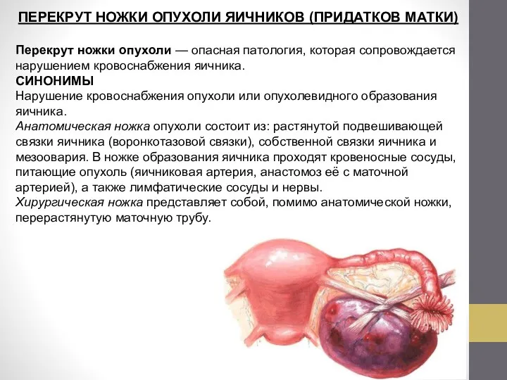 ПЕРЕКРУТ НОЖКИ ОПУХОЛИ ЯИЧНИКОВ (ПРИДАТКОВ МАТКИ) Перекрут ножки опухоли — опасная