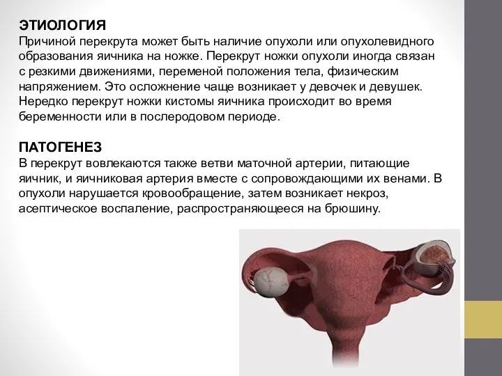 ЭТИОЛОГИЯ Причиной перекрута может быть наличие опухоли или опухолевидного образования яичника