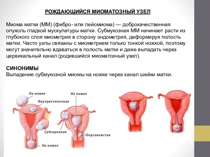 РОЖДАЮЩИЙСЯ МИОМАТОЗНЫЙ УЗЕЛ Миома матки (ММ) (фибро- или лейомиома) — доброкачественная