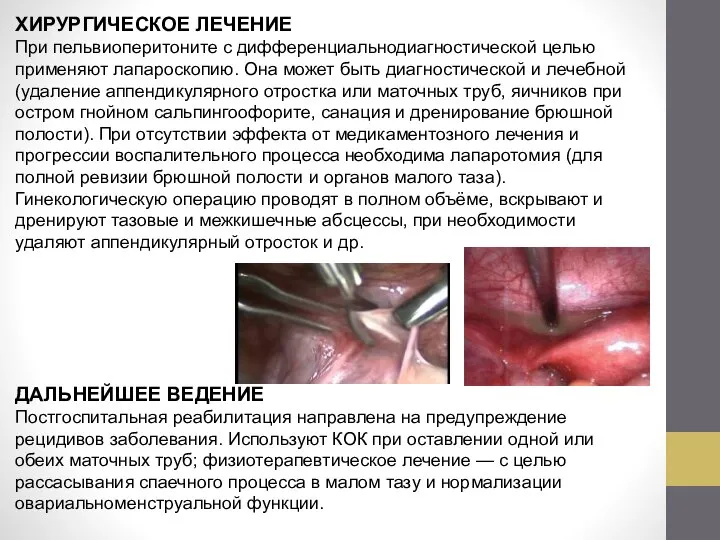 ХИРУРГИЧЕСКОЕ ЛЕЧЕНИЕ При пельвиоперитоните с дифференциальнодиагностической целью применяют лапароскопию. Она может