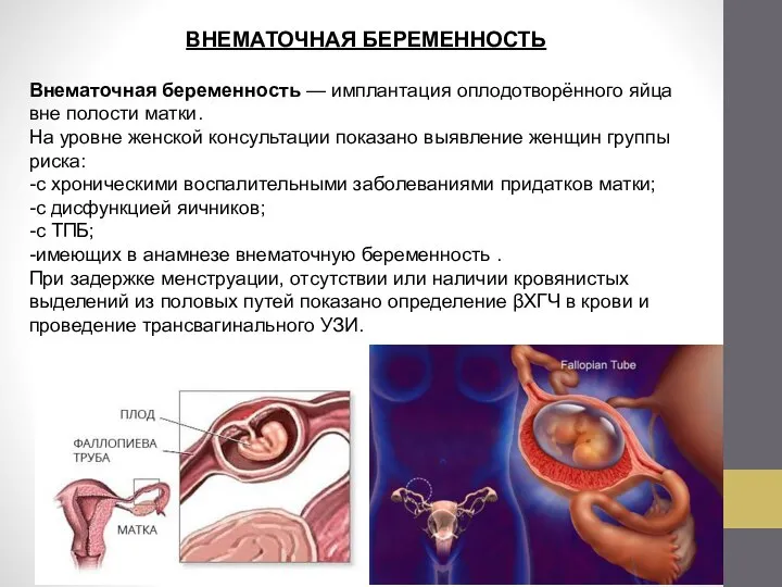 ВНЕМАТОЧНАЯ БЕРЕМЕННОСТЬ Внематочная беременность — имплантация оплодотворённого яйца вне полости матки.