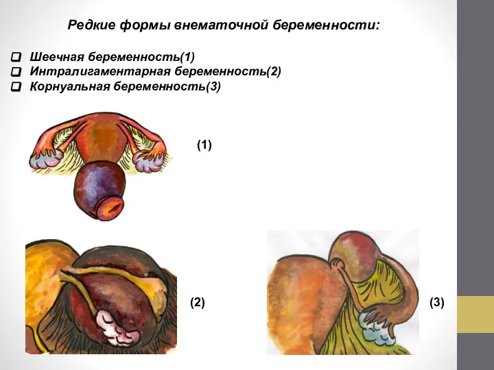 Редкие формы внематочной беременности: Шеечная беременность(1) Интралигаментарная беременность(2) Корнуальная беременность(3) (1) (2) (3)