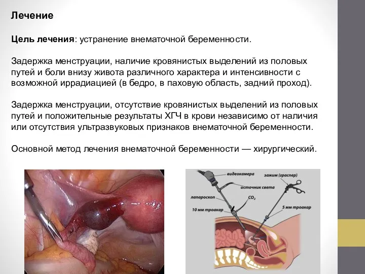 Лечение Цель лечения: устранение внематочной беременности. Задержка менструации, наличие кровянистых выделений