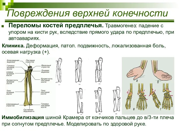 Переломы костей предплечья. Травмогенез: падение с упором на кисти рук, вследствие