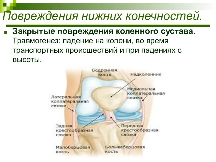 Закрытые повреждения коленного сустава. Травмогенез: падение на колени, во время транспортных