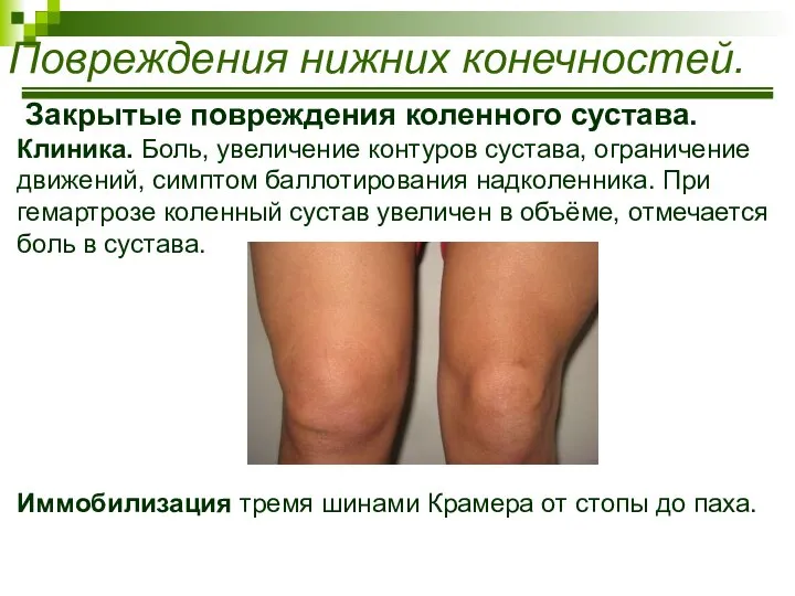 Закрытые повреждения коленного сустава. Клиника. Боль, увеличение контуров сустава, ограничение движений,