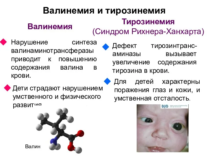 Валинемия и тирозинемия Валинемия Нарушение синтеза валинаминотрансферазы приводит к повышению содержания