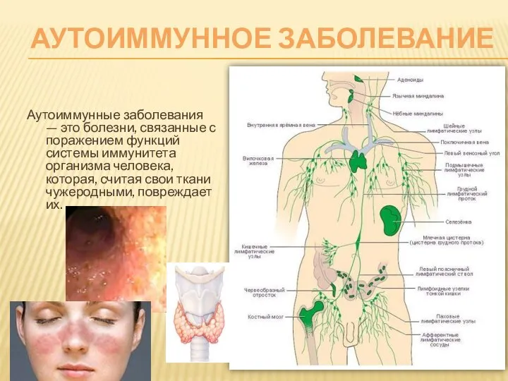 АУТОИММУННОЕ ЗАБОЛЕВАНИЕ Аутоиммунные заболевания — это болезни, связанные с поражением функций