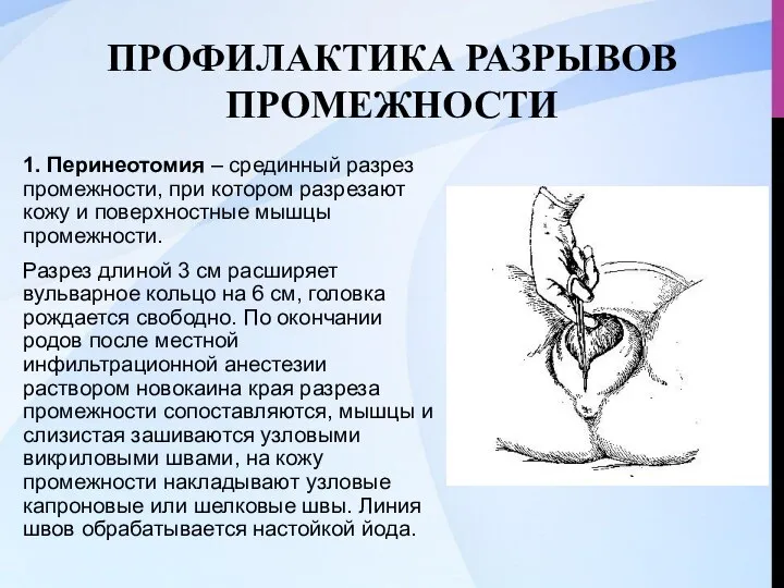 ПРОФИЛАКТИКА РАЗРЫВОВ ПРОМЕЖНОСТИ 1. Перинеотомия – срединный разрез промежности, при котором