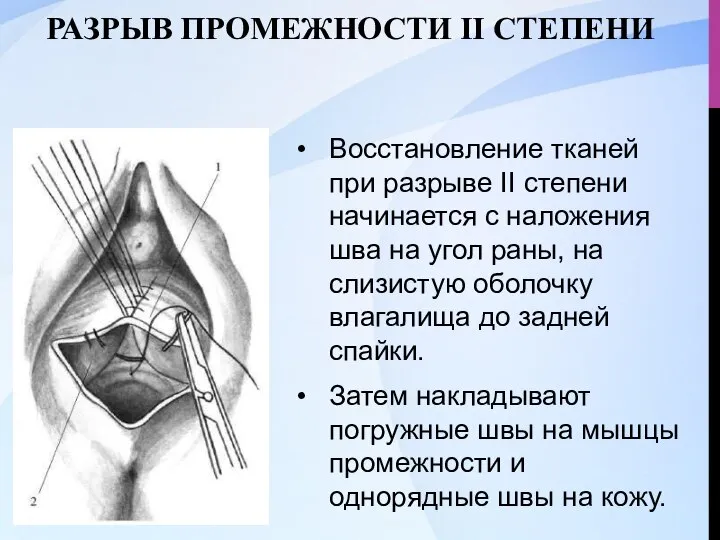 РАЗРЫВ ПРОМЕЖНОСТИ II СТЕПЕНИ Восстановление тканей при разрыве II степени начинается