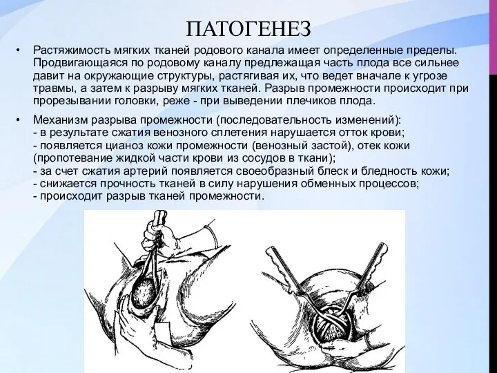 ПАТОГЕНЕЗ Растяжимость мягких тканей родового канала имеет определенные пределы. Продвигающаяся по