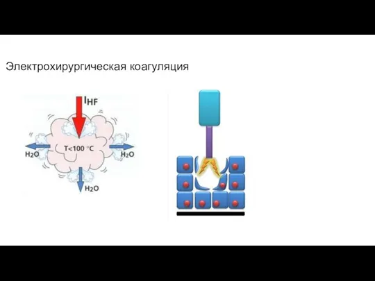 Электрохирургическая коагуляция