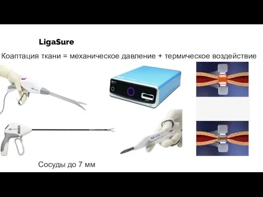 LigaSure Коаптация ткани = механическое давление + термическое воздействие Сосуды до 7 мм