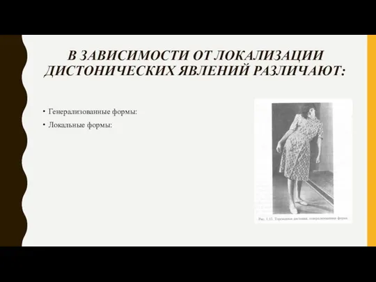 В ЗАВИСИМОСТИ ОТ ЛОКАЛИЗАЦИИ ДИСТОНИЧЕСКИХ ЯВЛЕНИЙ РАЗЛИЧАЮТ: Генерализованные формы: Локальные формы: