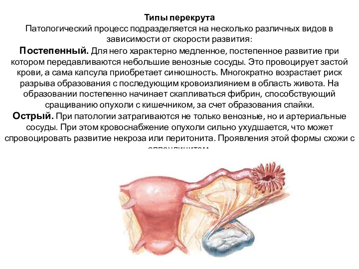 Типы перекрута Патологический процесс подразделяется на несколько различных видов в зависимости