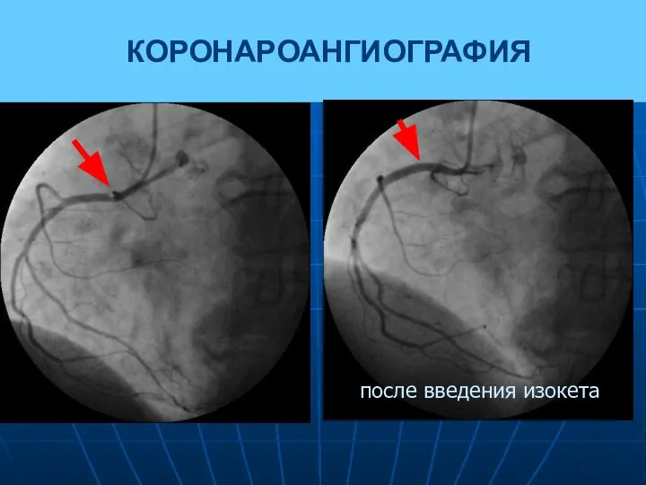 КОРОНАРОАНГИОГРАФИЯ после введения изокета