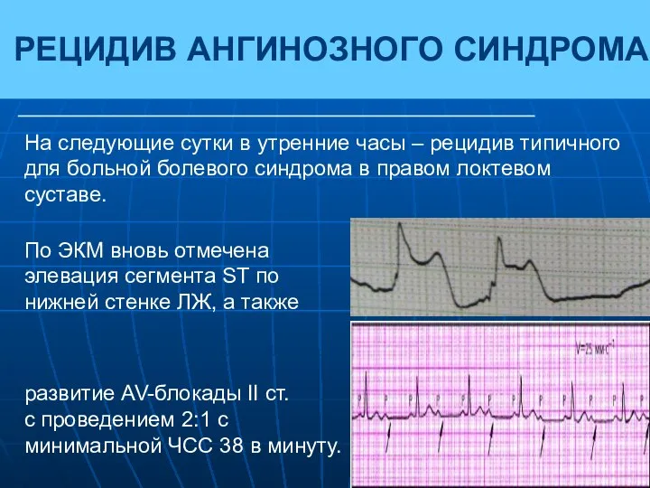 РЕЦИДИВ АНГИНОЗНОГО СИНДРОМА На следующие сутки в утренние часы – рецидив