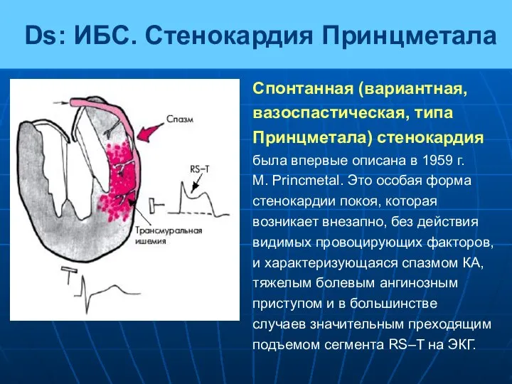 Спонтанная (вариантная, вазоспастическая, типа Принцметала) стенокардия была впервые описана в 1959