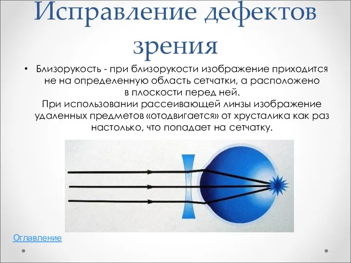 Исправление дефектов зрения Близорукость - при близорукости изображение приходится не на