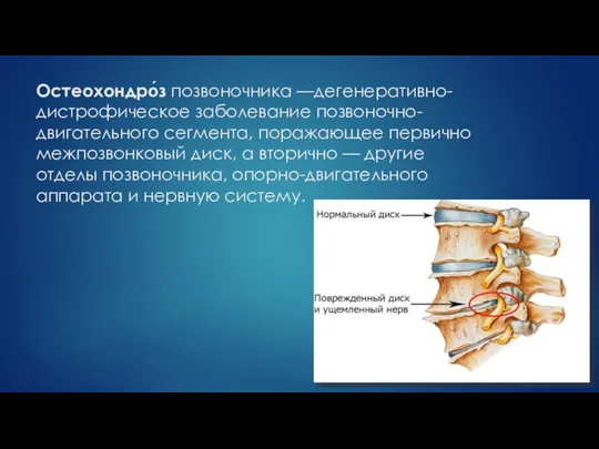 Остеохондро́з позвоночника —дегенеративно- дистрофическое заболевание позвоночно-двигательного сегмента, поражающее первично межпозвонковый диск,