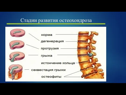 Стадии развития остеохондроза