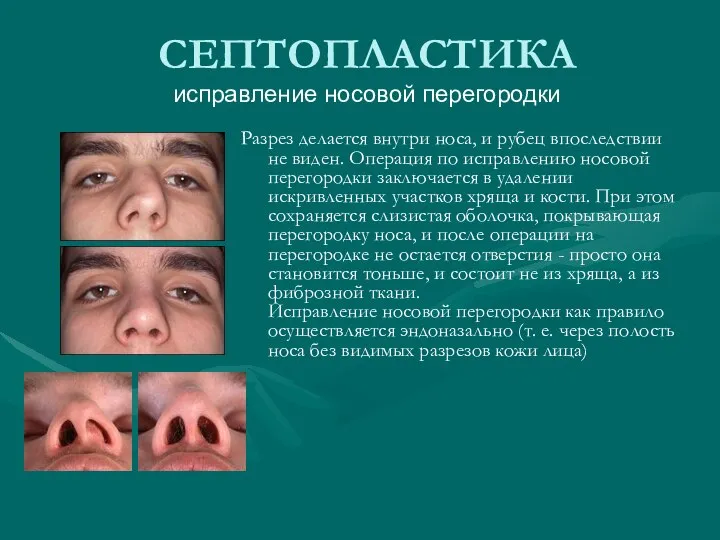 СЕПТОПЛАСТИКА исправление носовой перегородки Разрез делается внутри носа, и рубец впоследствии