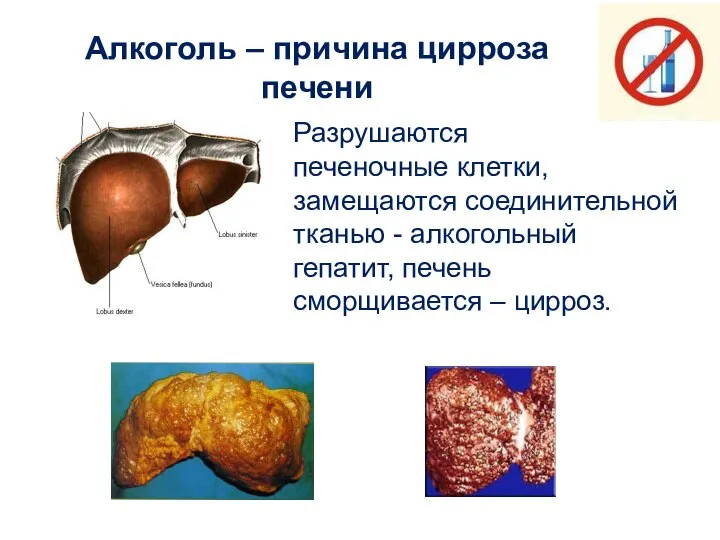 Алкоголь – причина цирроза печени Разрушаются печеночные клетки, замещаются соединительной тканью