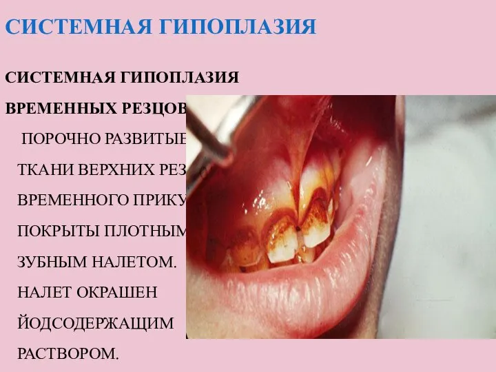 СИСТЕМНАЯ ГИПОПЛАЗИЯ СИСТЕМНАЯ ГИПОПЛАЗИЯ ВРЕМЕННЫХ РЕЗЦОВ ПОРОЧНО РАЗВИТЫЕ ТКАНИ ВЕРХНИХ РЕЗЦОВ