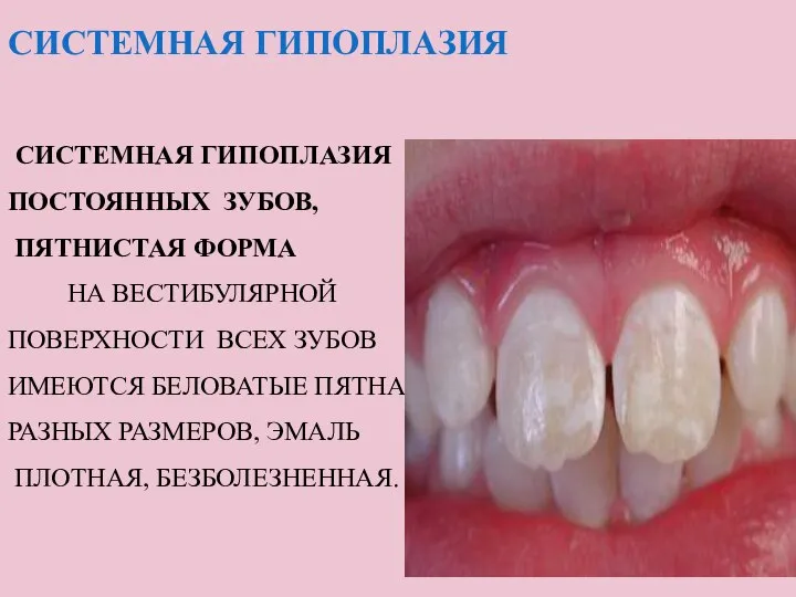 СИСТЕМНАЯ ГИПОПЛАЗИЯ СИСТЕМНАЯ ГИПОПЛАЗИЯ ПОСТОЯННЫХ ЗУБОВ, ПЯТНИСТАЯ ФОРМА НА ВЕСТИБУЛЯРНОЙ ПОВЕРХНОСТИ