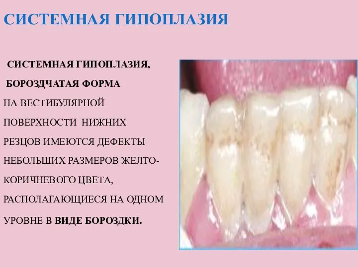 СИСТЕМНАЯ ГИПОПЛАЗИЯ СИСТЕМНАЯ ГИПОПЛАЗИЯ, БОРОЗДЧАТАЯ ФОРМА НА ВЕСТИБУЛЯРНОЙ ПОВЕРХНОСТИ НИЖНИХ РЕЗЦОВ