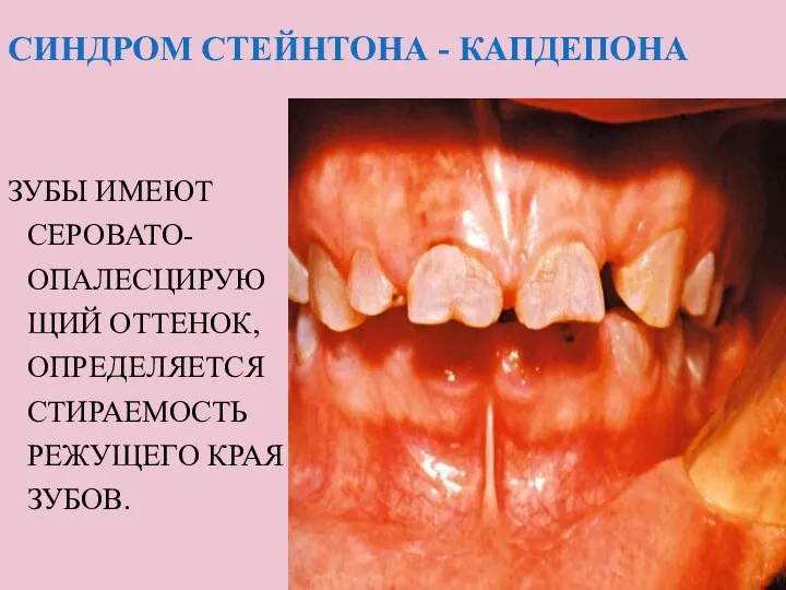 СИНДРОМ СТЕЙНТОНА - КАПДЕПОНА ЗУБЫ ИМЕЮТ СЕРОВАТО- ОПАЛЕСЦИРУЮЩИЙ ОТТЕНОК, ОПРЕДЕЛЯЕТСЯ СТИРАЕМОСТЬ РЕЖУЩЕГО КРАЯ ЗУБОВ.