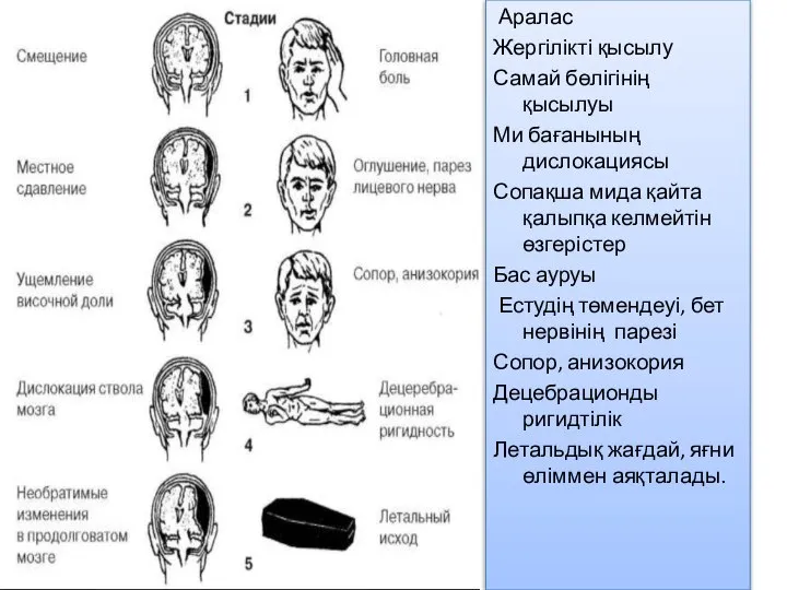 Аралас Жергілікті қысылу Самай бөлігінің қысылуы Ми бағанының дислокациясы Сопақша мида