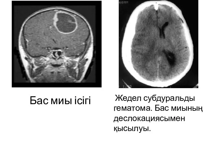 Бас миы ісігі Жедел субдуральды гематома. Бас миының деслокациясымен қысылуы.