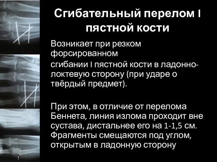 Сгибательный перелом I пястной кости Возникает при резком форсированном сгибании I