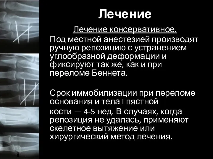 Лечение Лечение консервативное. Под местной анестезией производят ручную репозицию с устранением