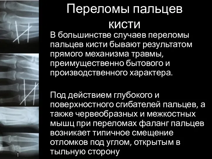 Переломы пальцев кисти В большинстве случаев переломы пальцев кисти бывают результатом