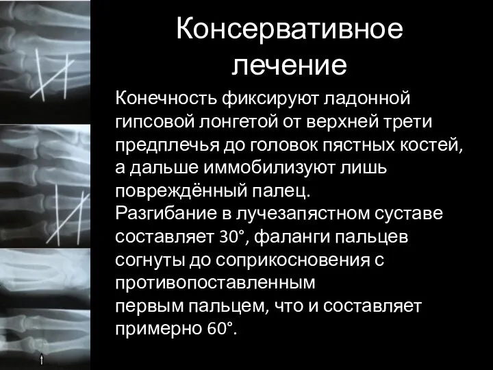 Консервативное лечение Конечность фиксируют ладонной гипсовой лонгетой от верхней трети предплечья