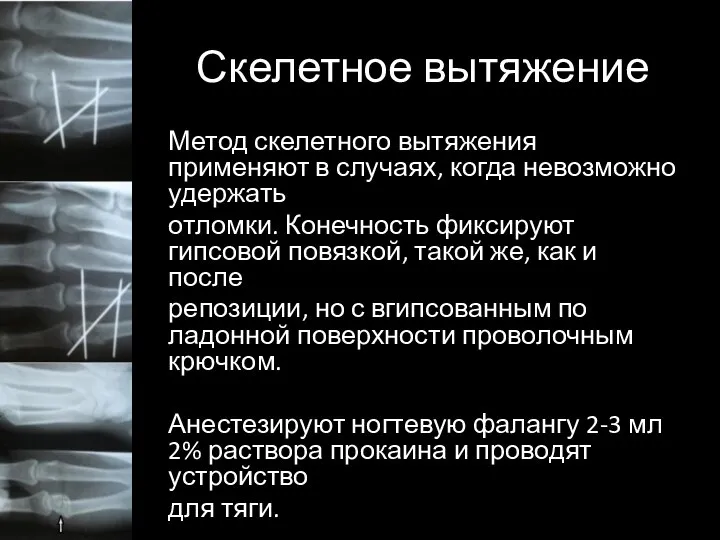 Скелетное вытяжение Метод скелетного вытяжения применяют в случаях, когда невозможно удержать