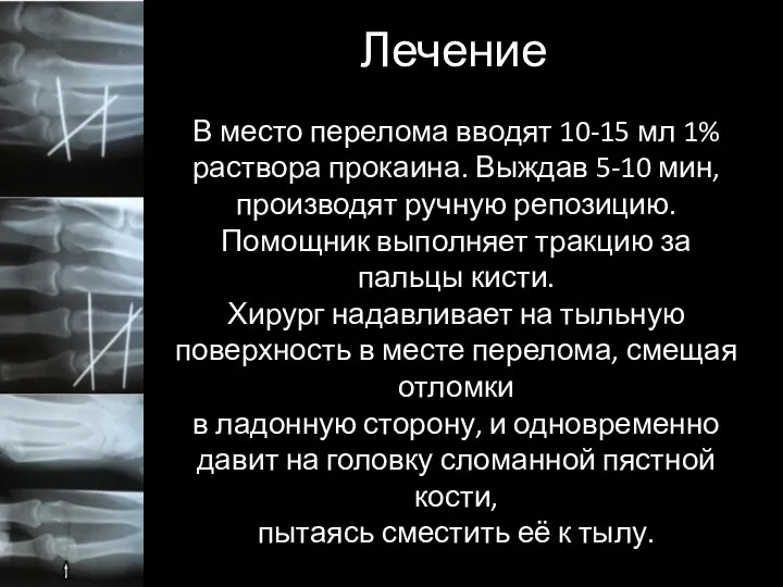 Лечение В место перелома вводят 10-15 мл 1% раствора прокаина. Выждав