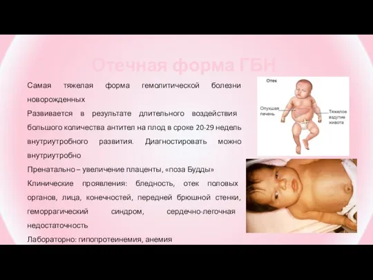 Отечная форма ГБН Самая тяжелая форма гемолитической болезни новорожденных Развивается в